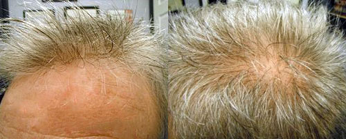 best mens hair restoration syracuse ny