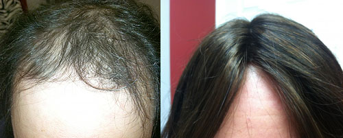 female alopecia hair loss replacement syracuse