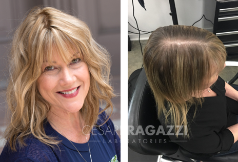 female-alopecia-hair-loss-restoration-replacement-syracuse-ny female alopecia hair loss restoration replacement syracuse ny