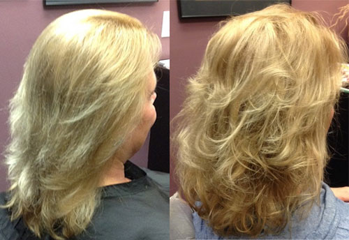 female hair loss restoration syracuse ny