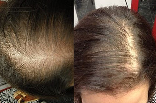 hair loss treatment clinic syracuse ny
