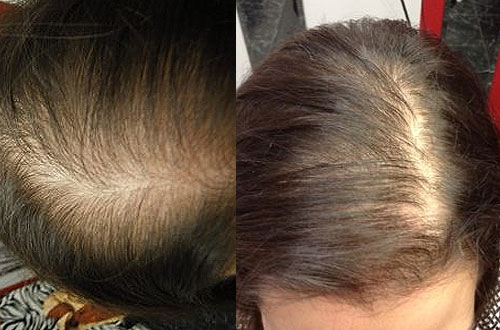 hair-loss-treatment hair loss treatment clinic syracuse ny