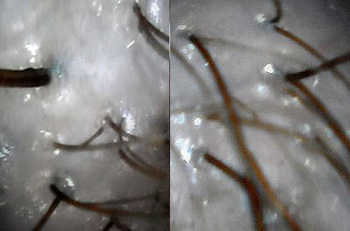 laser-hair-growth-therapy laser hair growth therapy