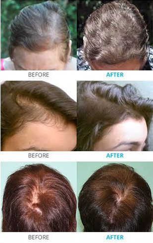 iGrow Laser Hair Growth System  McGrath Medical