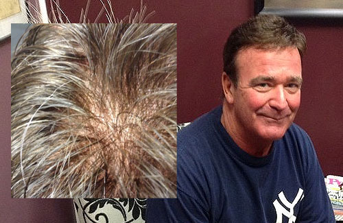 mens-hair-loss-replacement-syracuse mens hair loss replacement syracuse ny