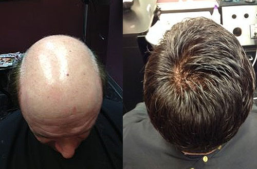 mens hair replacement central new york upstate