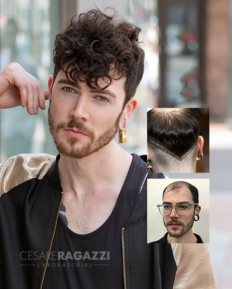 mens-hair-replacement-syracuse mens hair loss replacement Syracuse NY