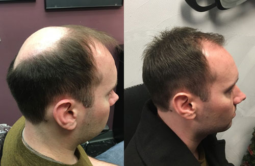 mens hair restoration syracuse ny