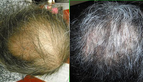 trichological scalp therapy