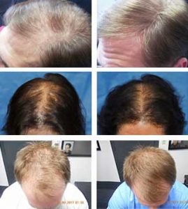laser hair loss treatment men women syracuse new york