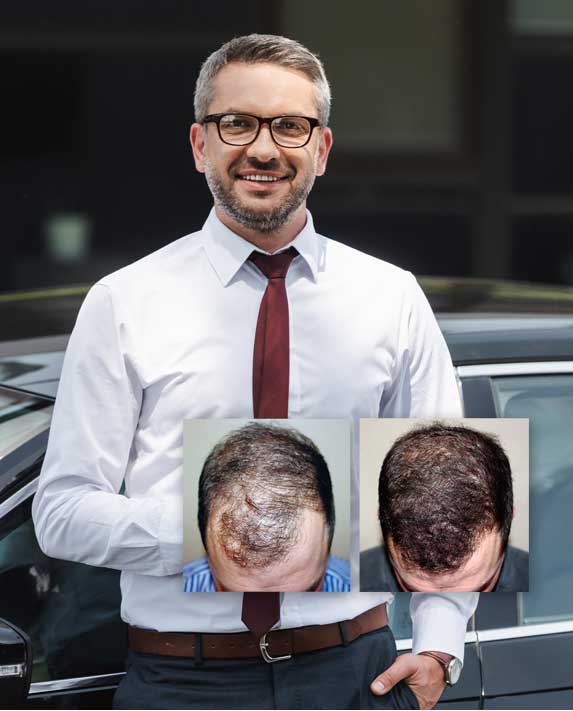 hair replacement transplant syracuse ny