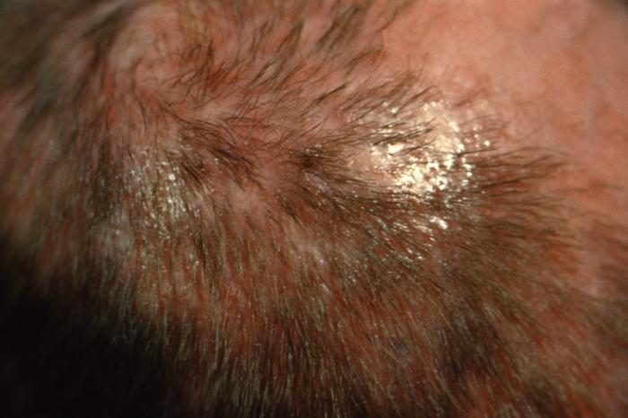 Childhood hair loss Ringworm